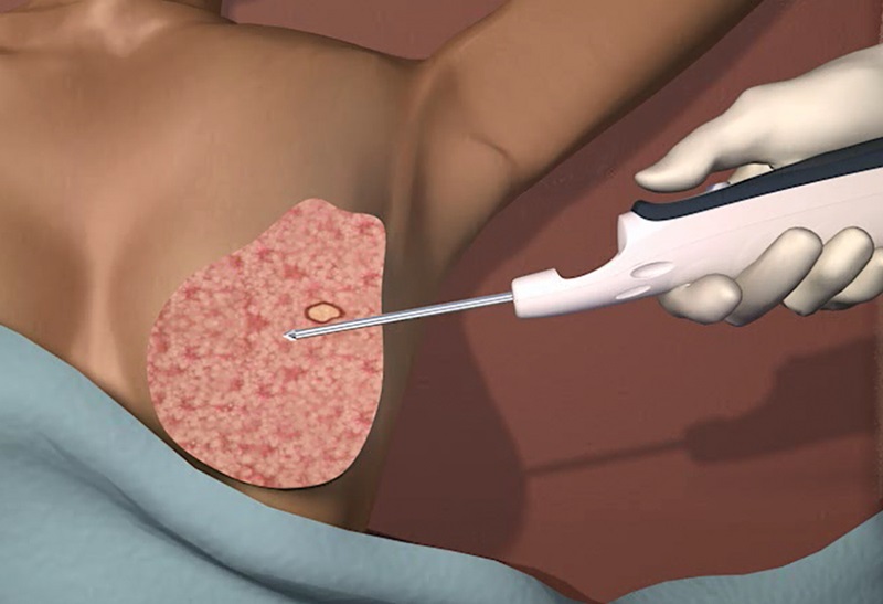 Mô phỏng kỹ thuật sinh thiết 