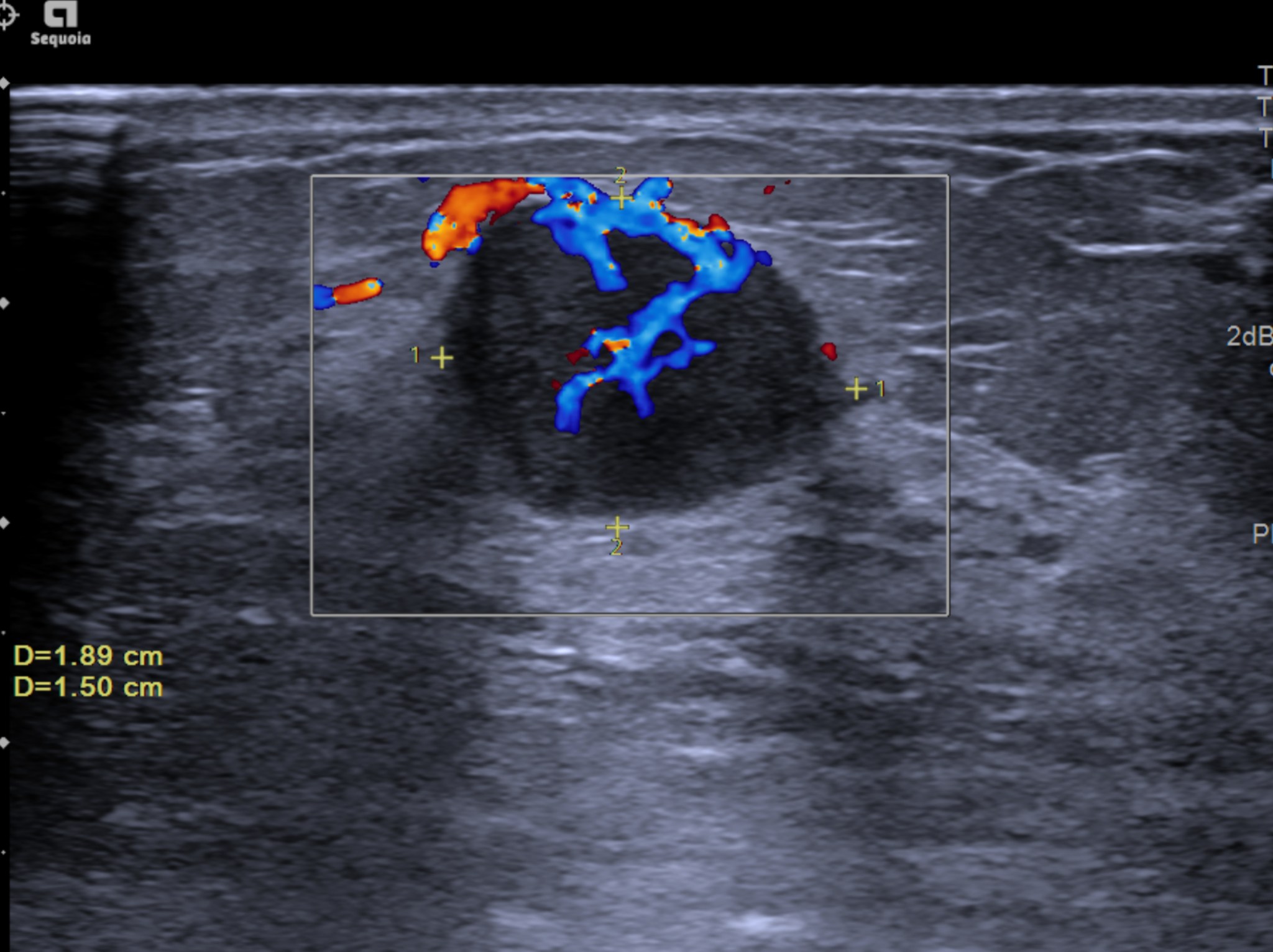 Khi nào cần sinh thiết u vú? Những dấu hiệu và tình huống cần chú ý