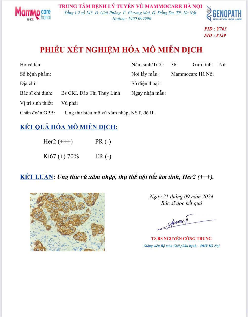 Thêm Một Trường Hợp Bệnh Nhân Trẻ Tuổi Mắc Ung Thư Vú