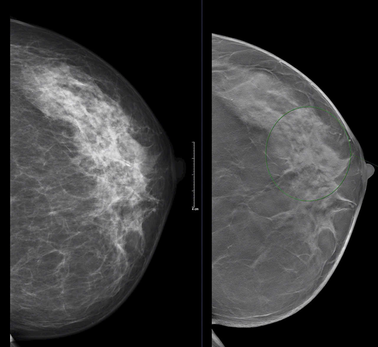 Nên Cẩn Trọng Khi Sờ Thấy Khối Hạch Ở Nách