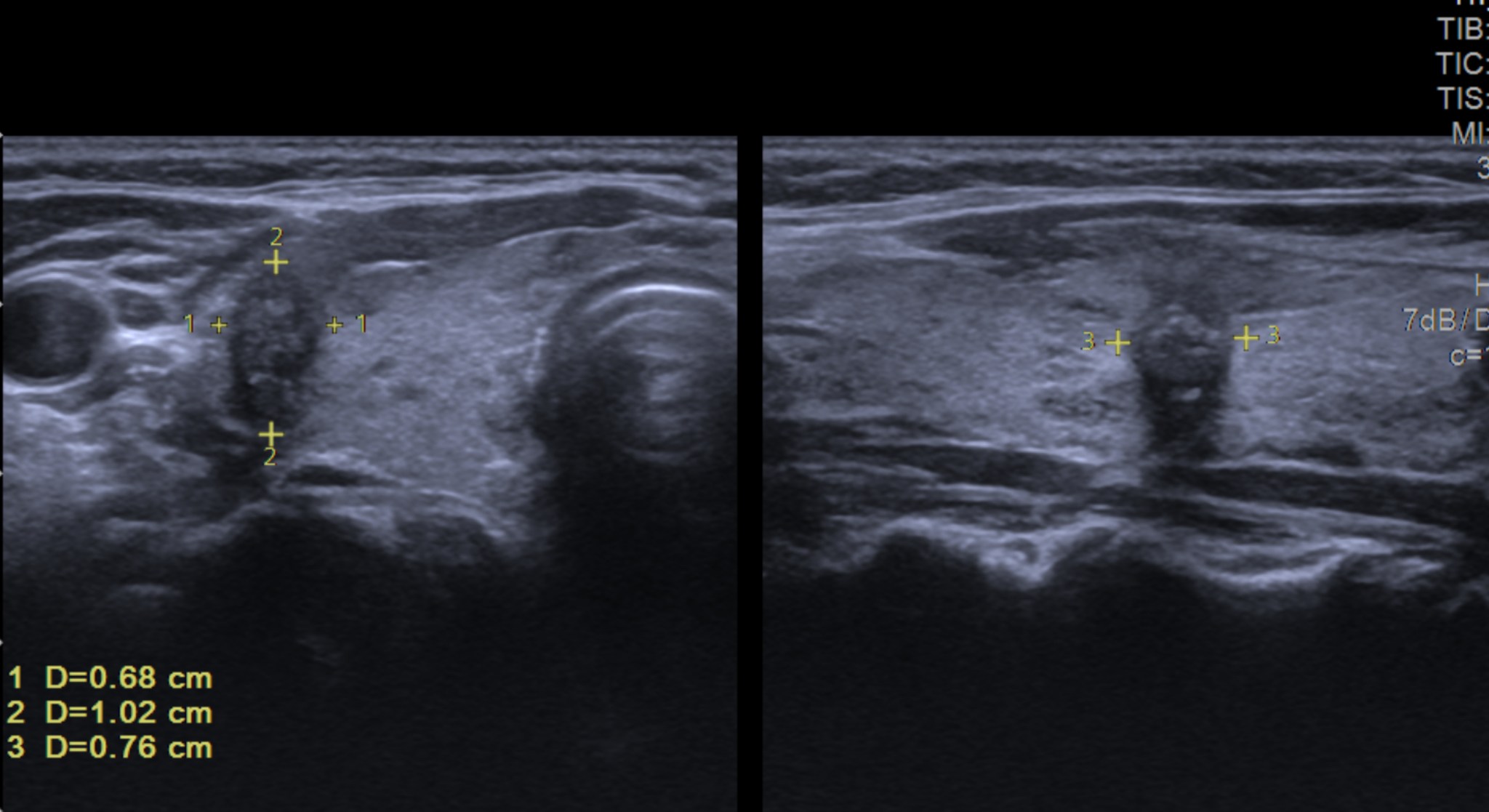Mối Liên Quan Giữa Ung Thư Vú Và Ung Thư Giáp: Nghiên Cứu Mới Và Nguy Cơ Tiềm Ẩn